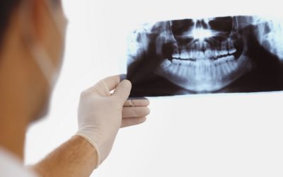 Wisdom Tooth Extraction