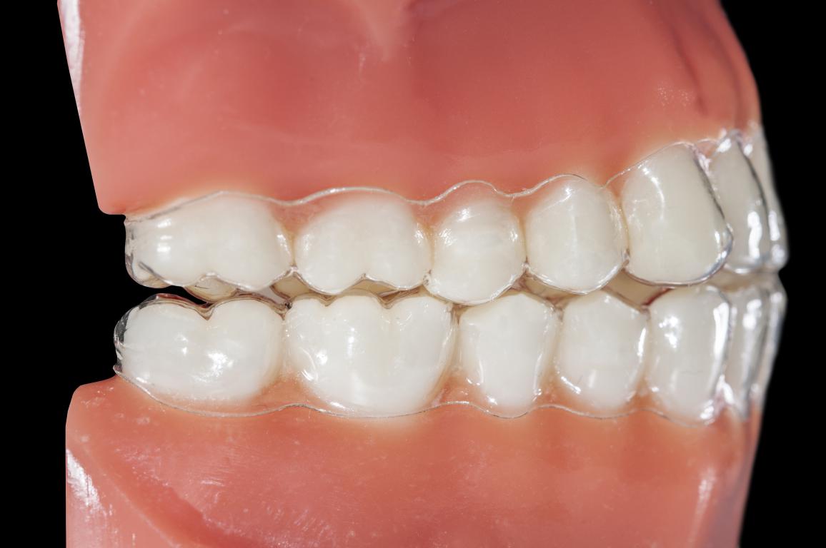occlusion dentaire et appareil orthodontique invisible