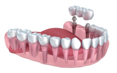 What is a Dental Implant?