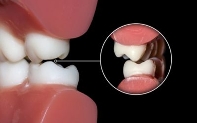 Dental Malocclusions and Orthodontic Treatments