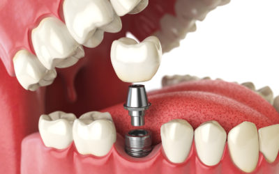 Dental Implants: Before Surgery