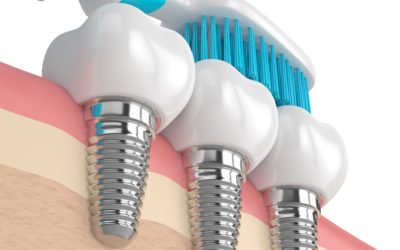 How to Maintain Your Implant Crowns?