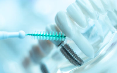 Maintaining Dental Implants