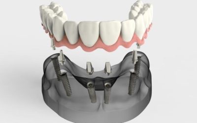 Full Mouth Treatment